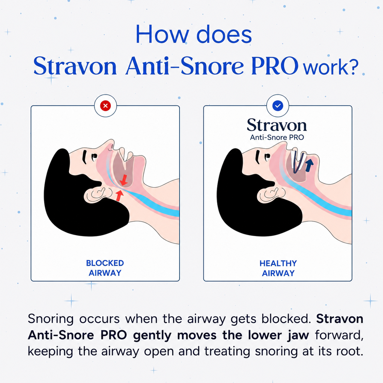 Stravon Anti-Snore PRO